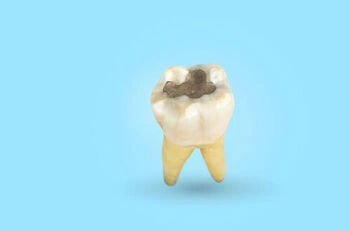 Tooth decay caused by acids produced by plaque bacteria