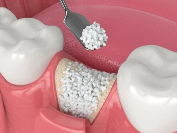 Illustration explaining what happens during a bone graft procedure
