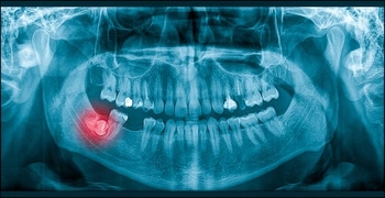 Diagram showing how an impacted wisdom tooth presses against the neighbouring molar