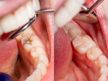 Illustration of what causes tooth decay on a tooth surface