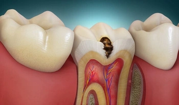 Decayed tooth cavity that requires restorative treatment