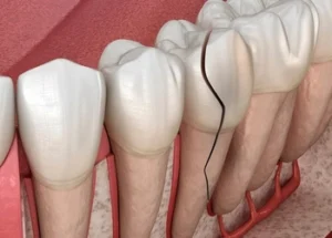 Illustration comparing normal enamel with a fractured tooth