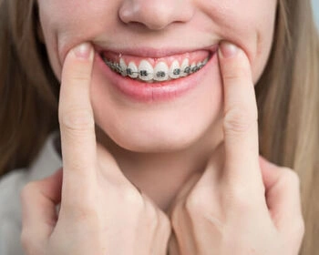 Orthodontic braces on a woman's teeth