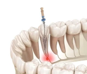 Illustration showing a tooth before and after root canal treatment